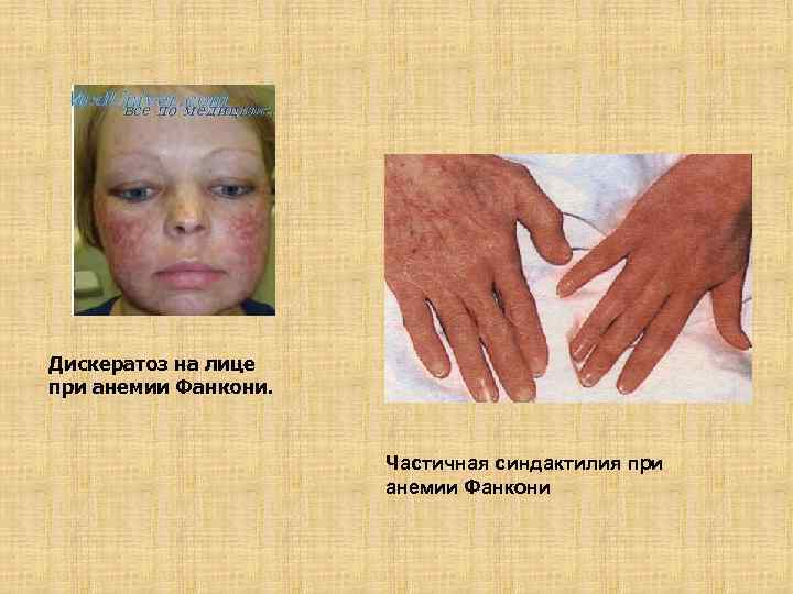 Дискератоз на лице при анемии Фанкони. Частичная синдактилия при анемии Фанкони 