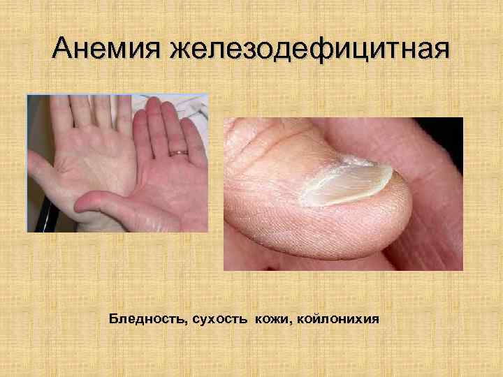 Анемия железодефицитная Бледность, сухость кожи, койлонихия 