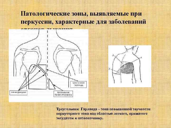 Патологические зоны, выявляемые при перкуссии, характерные для заболеваний органов дыхания Треугольник Гарланда – зона