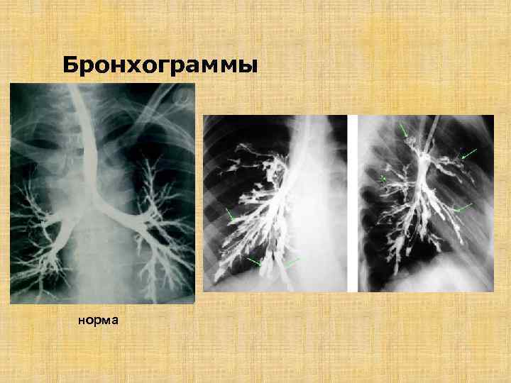 Бронхограммы норма 