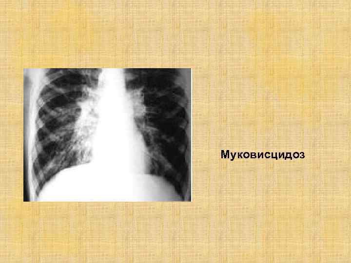 Муковисцидоз 