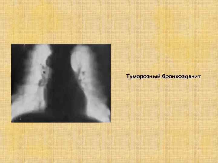 Туморозный бронхоаденит 