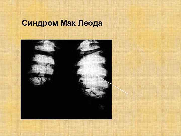 Синдром Мак Леода 