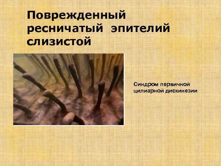 Поврежденный ресничатый эпителий слизистой Синдром первичной цилиарной дискинезии 