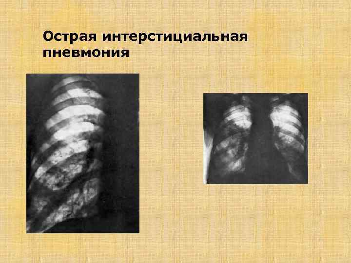 Острая интерстициальная пневмония 