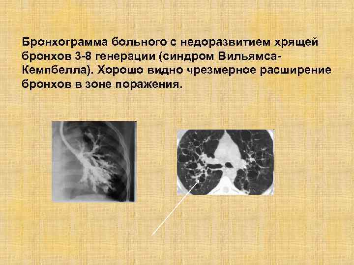 Бронхограмма больного с недоразвитием хрящей бронхов 3 -8 генерации (синдром Вильямса. Кемпбелла). Хорошо видно