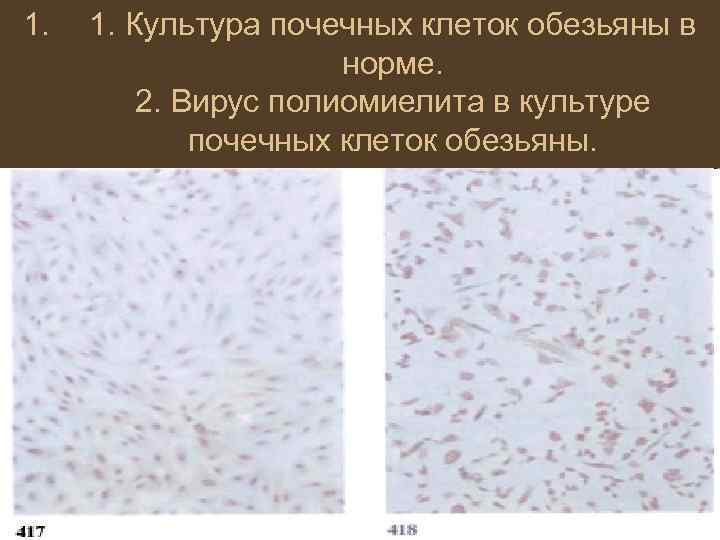 1. 1. Культура почечных клеток обезьяны в норме. 2. Вирус полиомиелита в культуре почечных