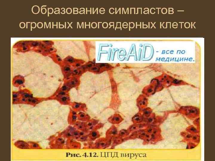 Образование симпластов – огромных многоядерных клеток 