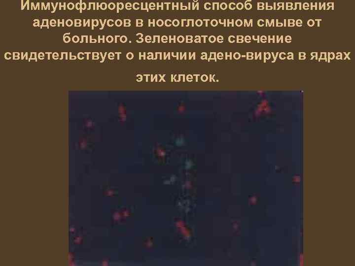 Иммунофлюоресцентный способ выявления аденовирусов в носоглоточном смыве от больного. Зеленоватое свечение свидетельствует о наличии
