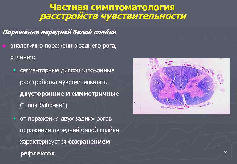 Частная симптоматология расстройств чувствительности Поражение передней белой спайки ► аналогично поражению заднего рога, отличия: