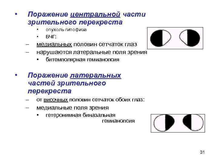  • Поражение центральной части зрительного перекреста • • – – медиальных половин сетчаток