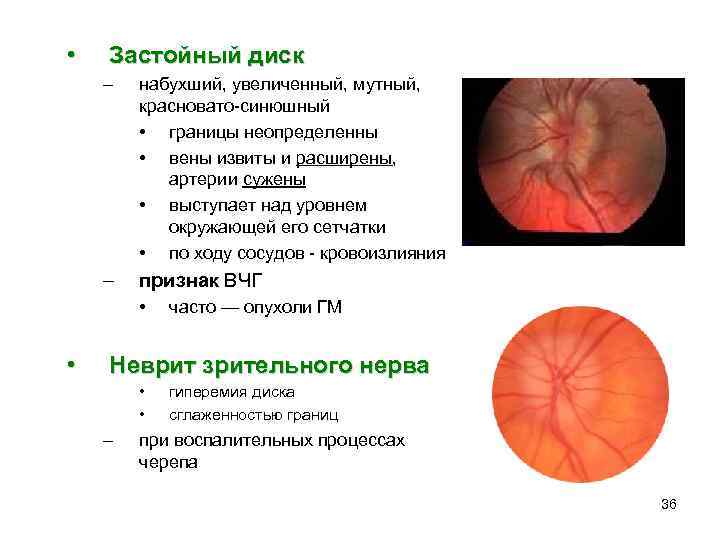  • Застойный диск – набухший, увеличенный, мутный, красновато-синюшный • границы неопределенны • вены