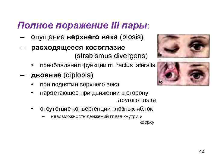 Полное поражение III пары: – опущение верхнего века (ptosis) – расходящееся косоглазие (strabismus divergens)