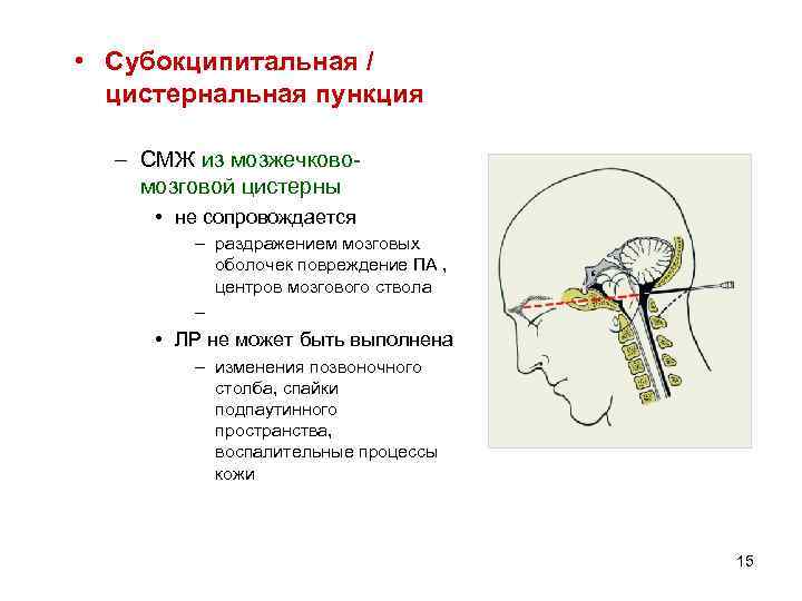  • Субокципитальная / цистернальная пункция – СМЖ из мозжечковомозговой цистерны • не сопровождается