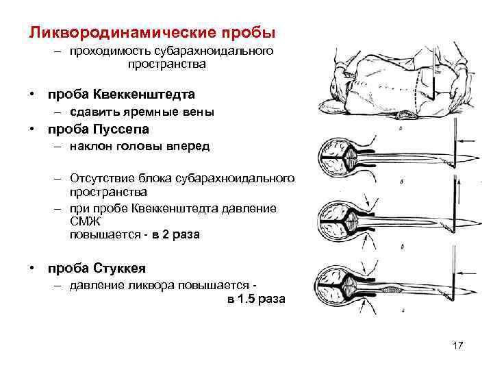 Ликвородинамические пробы – проходимость субарахноидального пространства • проба Квеккенштедта – сдавить яремные вены •