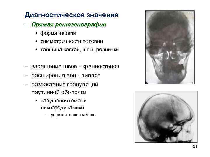 Диагностическое значение – Прямая рентгенография • форма черепа • симметричности половин • толщина костей,