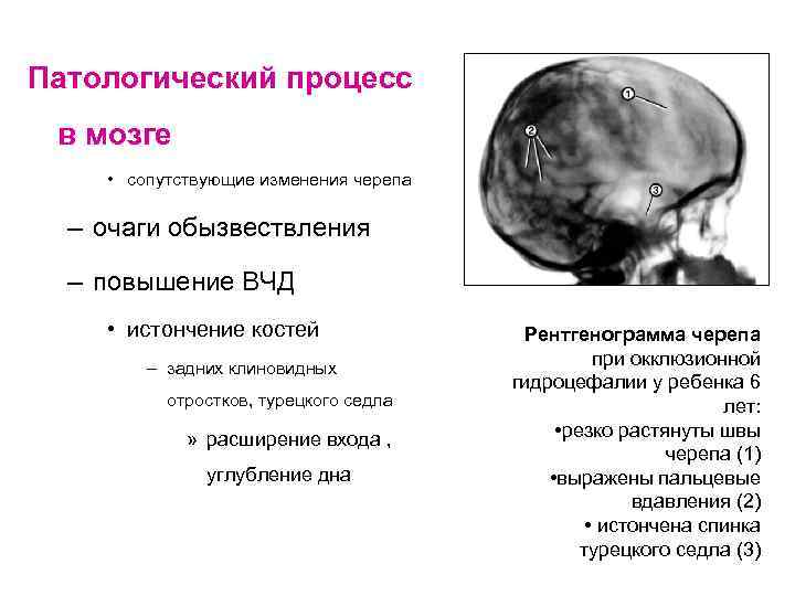Патологический процесс в мозге • сопутствующие изменения черепа – очаги обызвествления – повышение ВЧД