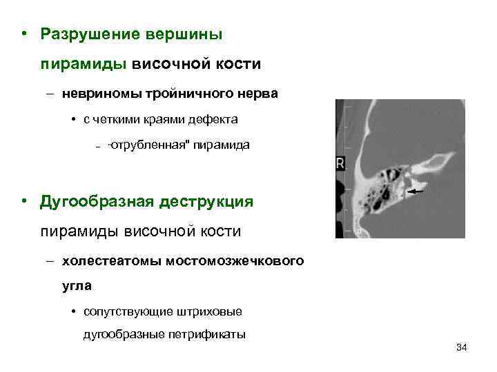  • Разрушение вершины пирамиды височной кости – невриномы тройничного нерва • с четкими