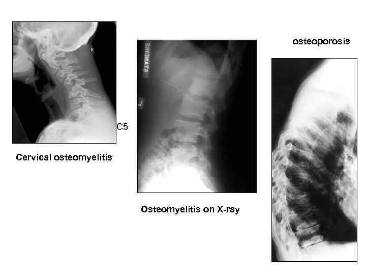osteoporosis C 5 Cervical osteomyelitis Osteomyelitis on X-ray 