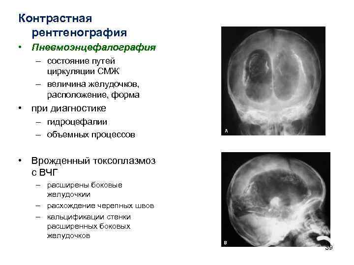 Контрастная рентгенография • Пневмоэнцефалография – состояние путей циркуляции СМЖ – величина желудочков, расположение, форма