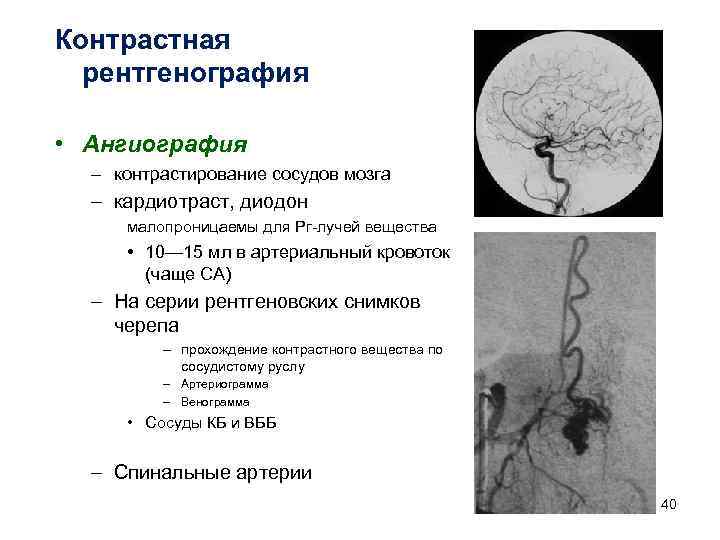 Контрастная рентгенография • Ангиография – контрастирование сосудов мозга – кардиотраст, диодон малопроницаемы для Рг-лучей