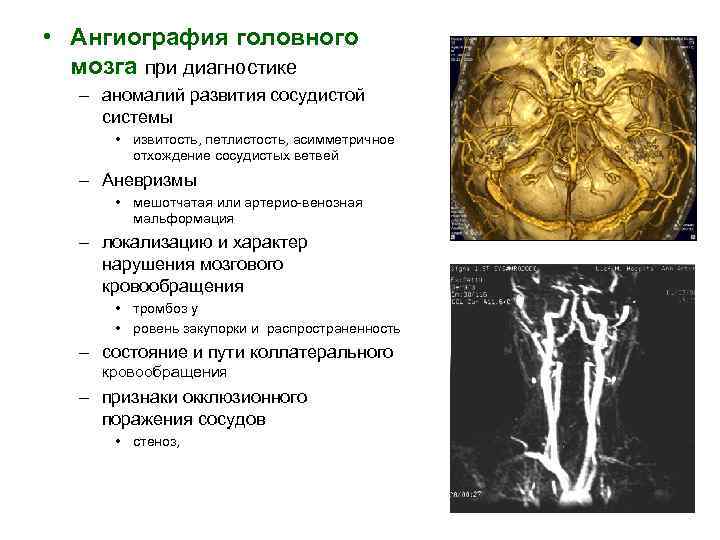  • Ангиография головного мозга при диагностике – аномалий развития сосудистой системы • извитость,