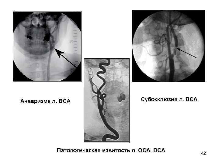 Аневризма л. ВСА Субокклюзия л. ВСА Патологическая извитость л. ОСА, ВСА 42 