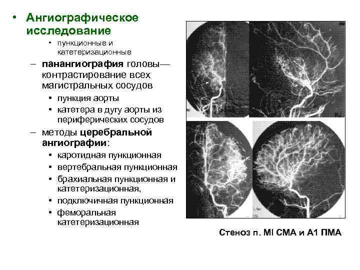  • Ангиографическое исследование • пункционные и катетеризационные – панангиография головы— контрастирование всех магистральных