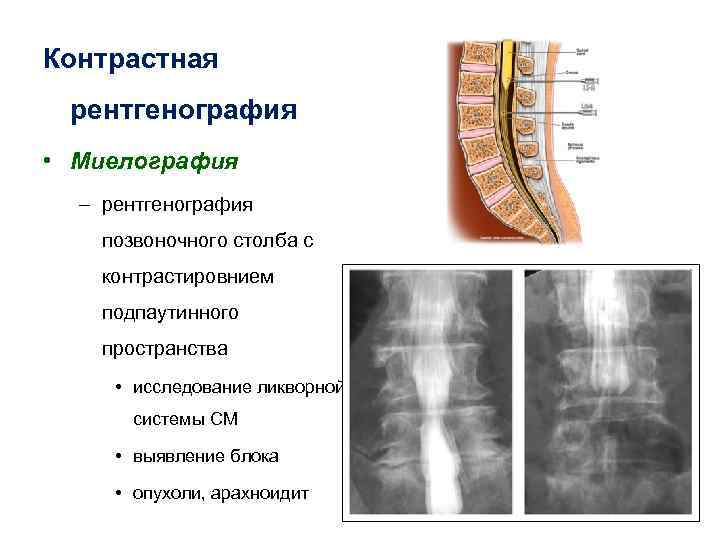 Контрастная рентгенография • Миелография – рентгенография позвоночного столба с контрастировнием подпаутинного пространства • исследование