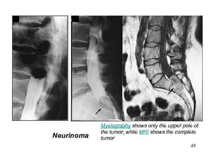 Neurinoma Myelography shows only the upper pole of the tumor, while MRI shows the