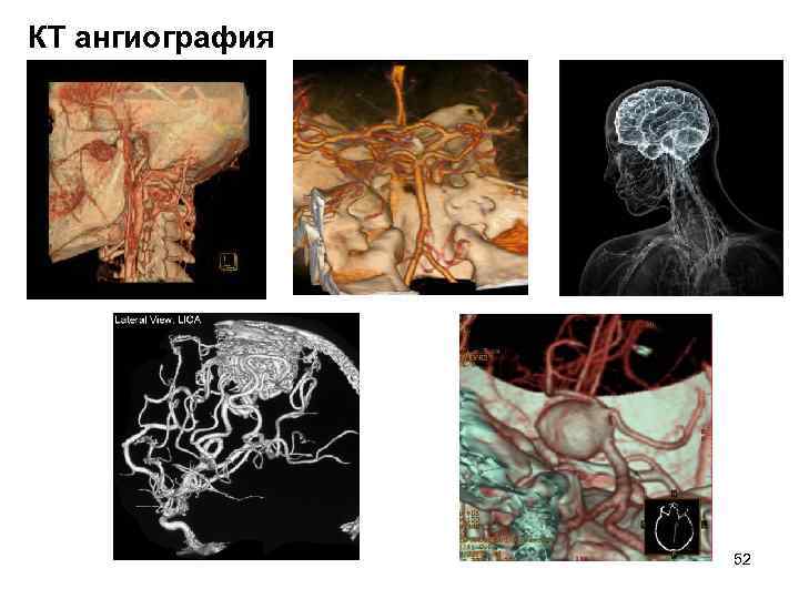 КТ ангиография 52 