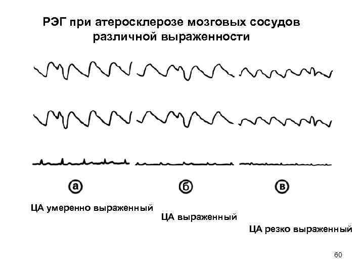 РЭГ при атеросклерозе мозговых сосудов различной выраженности ЦА умеренно выраженный ЦА резко выраженный 60