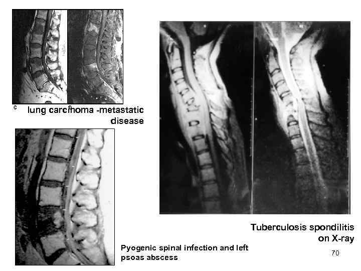 lung carcinoma -metastatic disease Tuberculosis spondilitis on X-ray Pyogenic spinal infection and left psoas