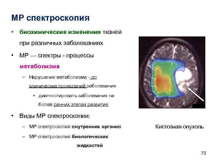 МР спектроскопия • биохимические изменения тканей при различных заболеваниях • МР — спектры -