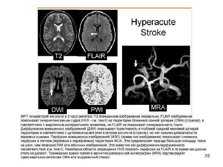 МРТ гиперострой инсульта в 2 часа postictus. T 2 -взвешенное изображение нормально. FLAIR изображение