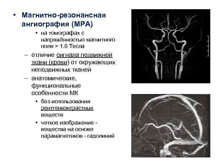  • Магнитно-резонансная ангиография (МРА) • на томографах с напряжённостью магнитного поля > 1.
