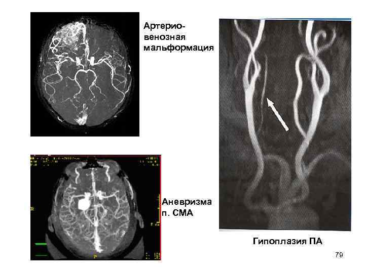Артериовенозная мальформация Аневризма п. СМА Гипоплазия ПА 79 