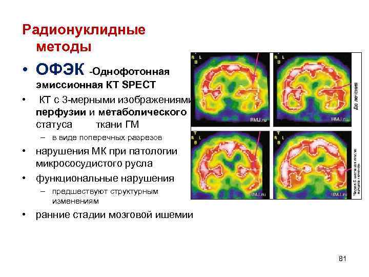 Радионуклидные методы • ОФЭК -Однофотонная эмиссионная КТ SPECT • КТ с 3 -мерными изображениями