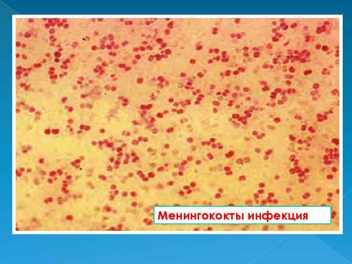 Менингококты инфекция 