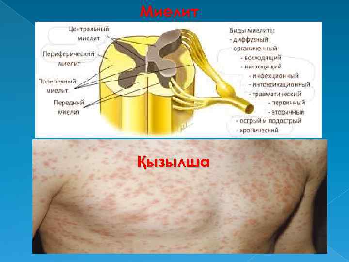 Миелит Қызылша 