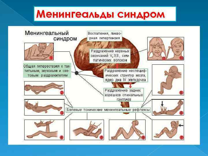 Менингеальды синдром 
