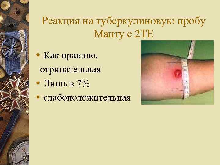 Реакция на туберкулиновую пробу Манту с 2 ТЕ w Как правило, отрицательная w Лишь