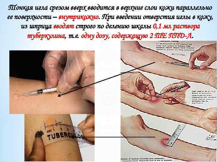 Тонкая игла срезом вверх вводится в верхние слои кожи параллельно ее поверхности – внутрикожно.
