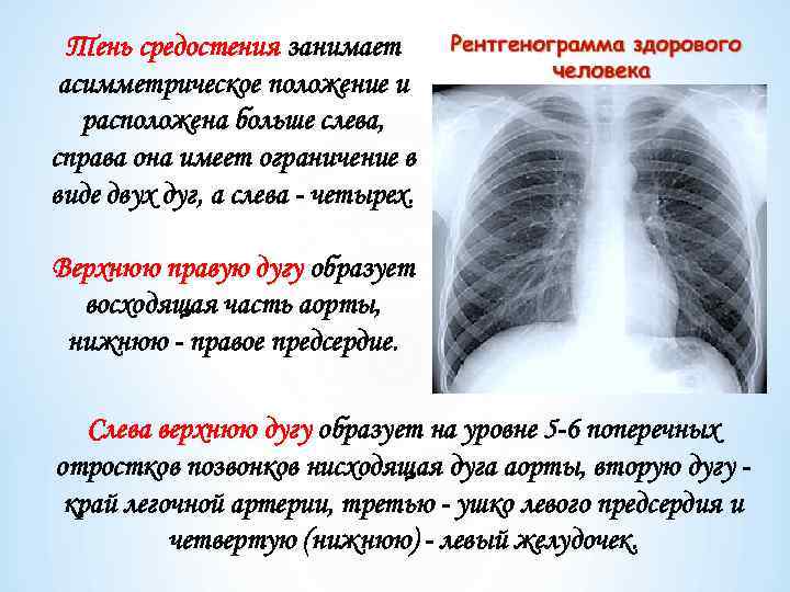 Тень средостения занимает асимметрическое положение и расположена больше слева, справа она имеет ограничение в