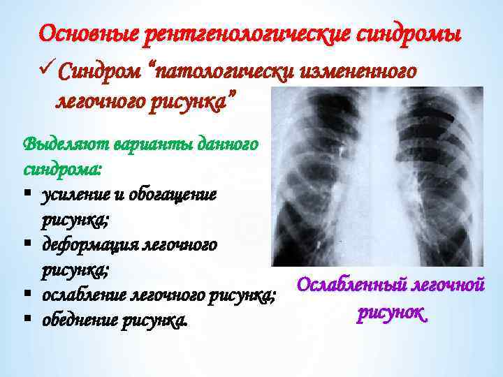 Усилен сосудистый компонент легочного рисунка. Легочный рисунок обогащен и деформирован. Усиление и обогащение легочного рисунка. Легочный рисунок усилен деформирован. Синдром усиления легочного рисунка.