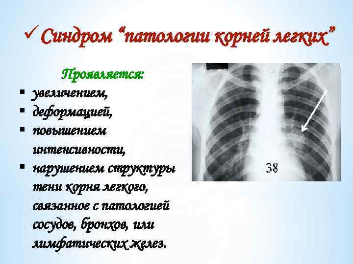 üСиндром “патологии корней легких” § § Проявляется: увеличением, деформацией, повышением интенсивности, нарушением структуры тени