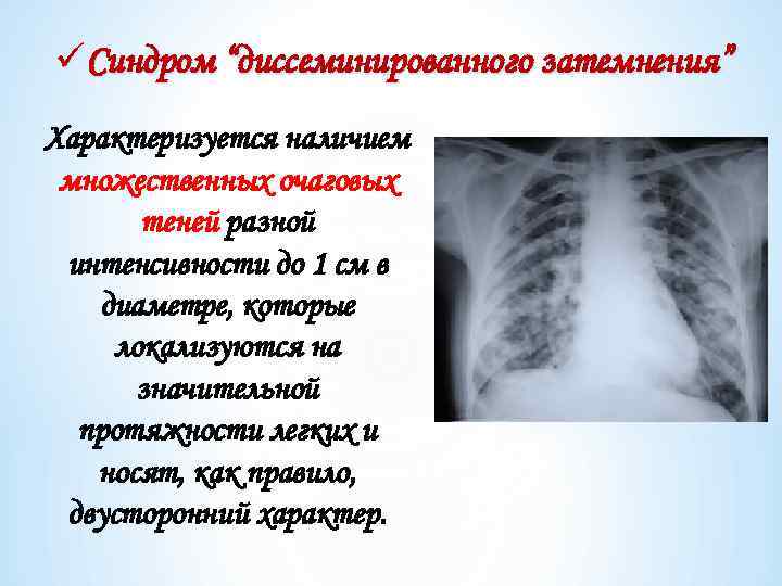 üСиндром “диссеминированного затемнения” Характеризуется наличием множественных очаговых теней разной интенсивности до 1 см в