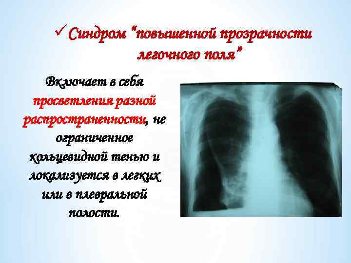 üСиндром “повышенной прозрачности легочного поля” Включает в себя просветления разной распространенности, не ограниченное кольцевидной