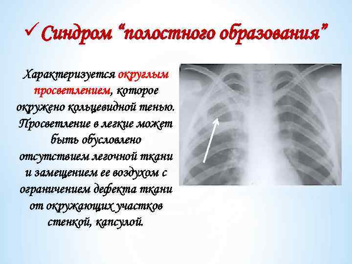 üСиндром “полостного образования” Характеризуется округлым просветлением, которое окружено кольцевидной тенью. Просветление в легкие может