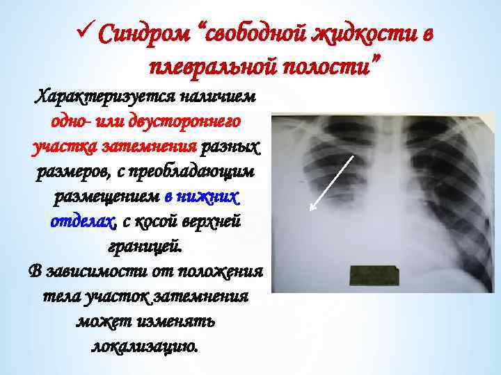 üСиндром “свободной жидкости в плевральной полости” Характеризуется наличием одно- или двустороннего участка затемнения разных